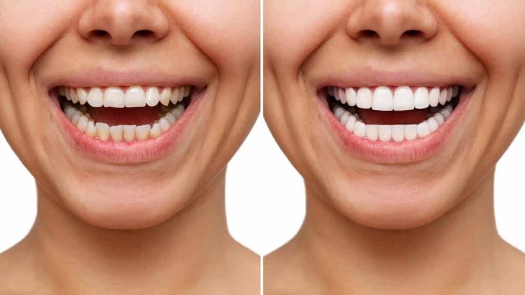 Before and after teeth whitening results. Wigan