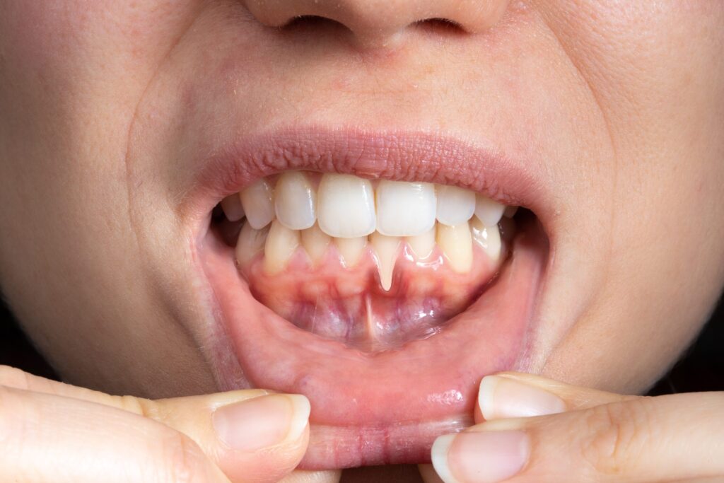 Preparing for teeth whitening with receding gums Wigan